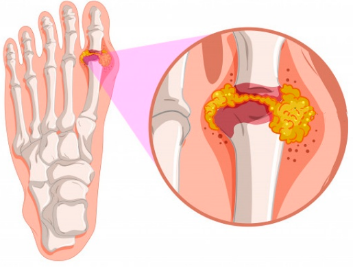 Artritis Reumatoide