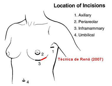 inciciones en cirugia de senos