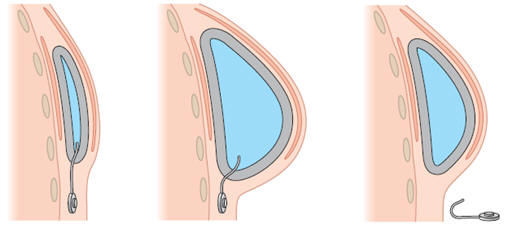 Implantes de mama inflables