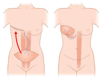 Impolante de mama por abdomen