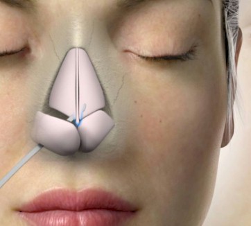 cirugia funcional nariz