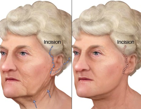 ESTIRAMIENTO FACIAL