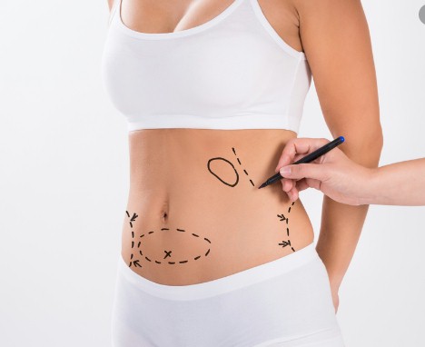 TODO SOBRE LIPOESCULTURA