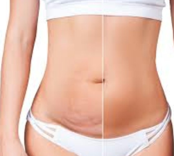 LIPOSUCCION Y ABDOMINOPLASTIA