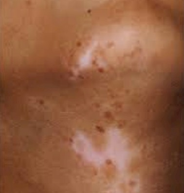 vitiligo guayaquil