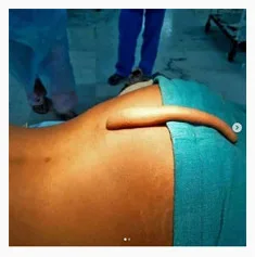 El Ronquido es peligroso
