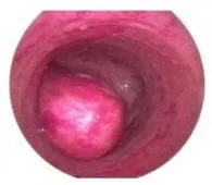 eliminación de pólipos endometriales con histeroscopía